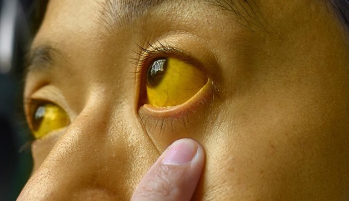 https://www.mdanderson.org/cancerwise/2024/08/what-causes-jaundice-in-adults/jcr%3Acontent/blog/adaptiveimage.resize.702.404.jpg