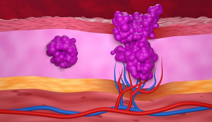 Benign vs. malignant tumors: Their differences, explained