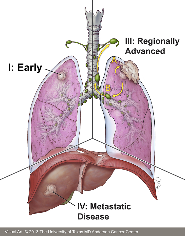 lung cancer icd 9