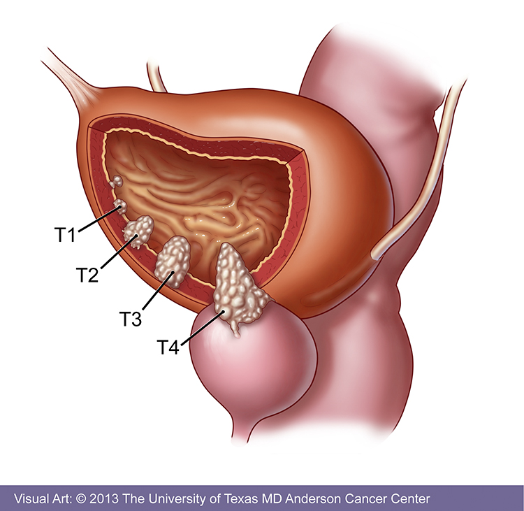 Aggressive cancer in bladder - Colon detoxifiere