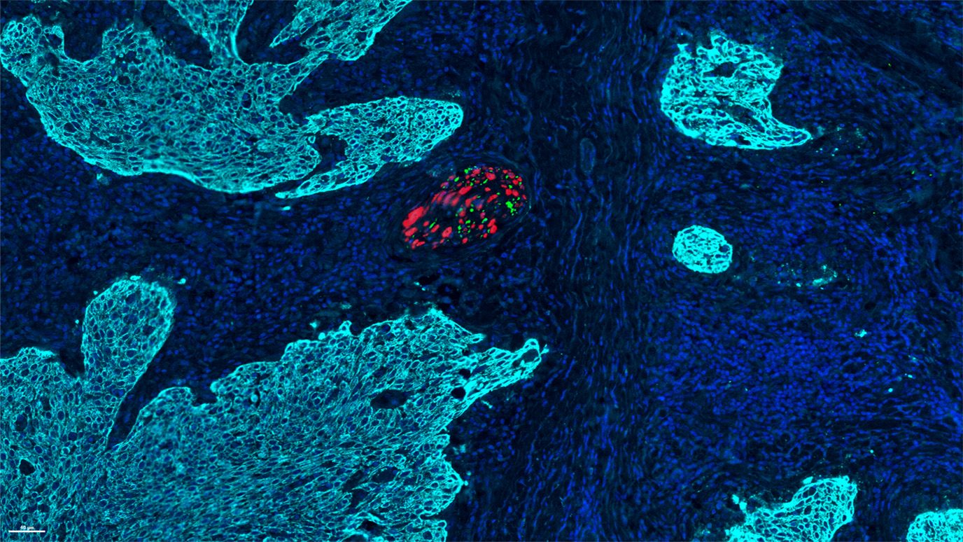Immunofluorescence image of the tumor neural microenvironment in a radiation-treated patient with dysphagia showing enrichment of certain nerves (red and green). Image courtesy of the Amit lab.