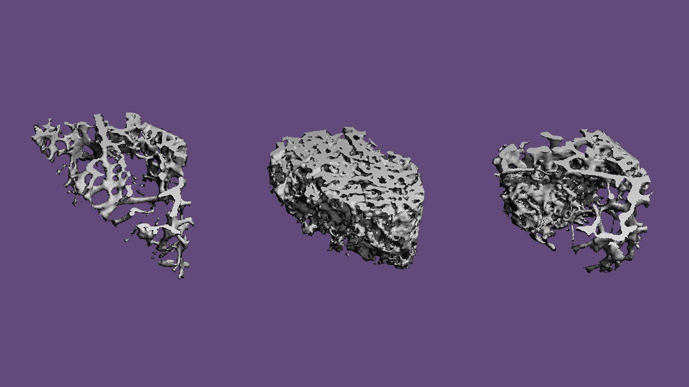 representative images of MTC bone metastases