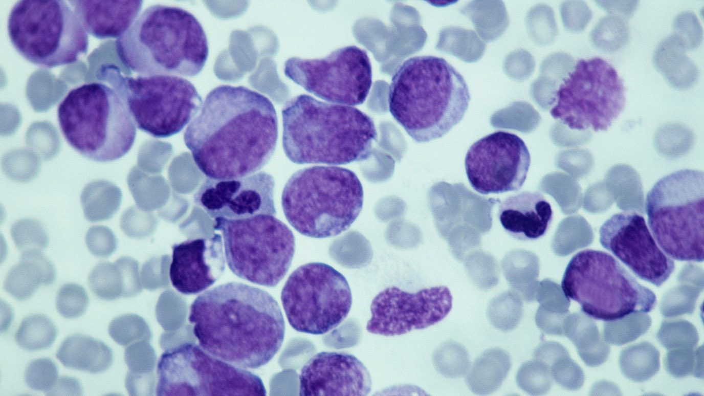 Leukemia cells under microscope