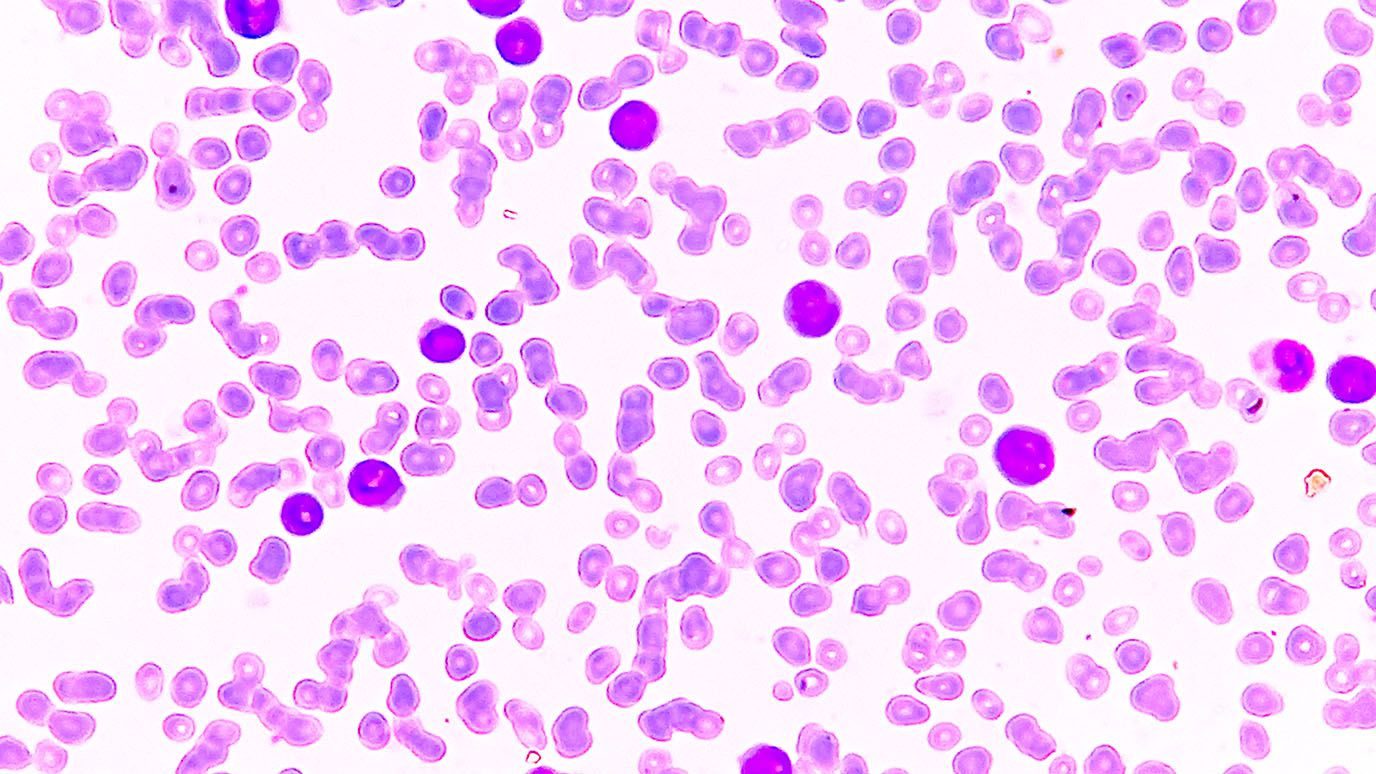 Acute myeloid leukemia (AML) smear showing monocytes and blast cells.
