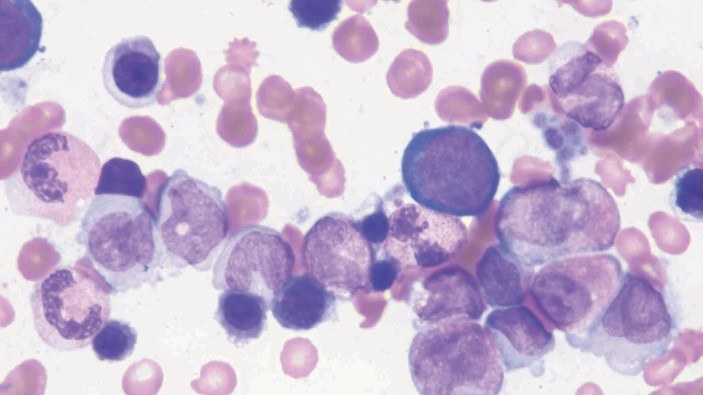 A microscopic view of CMML cells