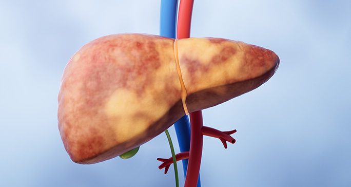 Medical illustration of fatty liver