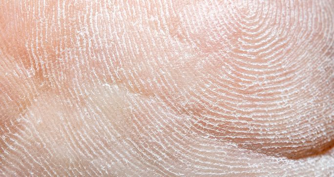 Close-up view of dry, scaly skin