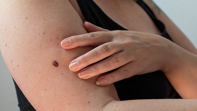 Torso of a woman in a black tank top with a brown mole on her upper arm