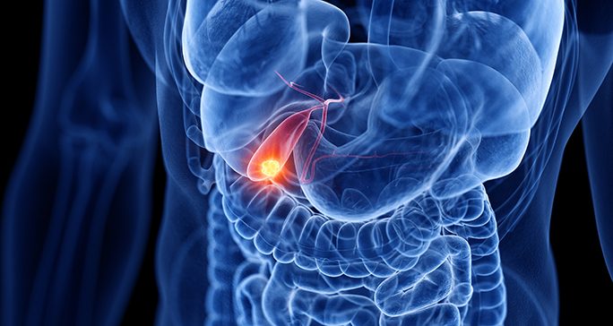 Image of a cancerous tumor located in the gallbladder