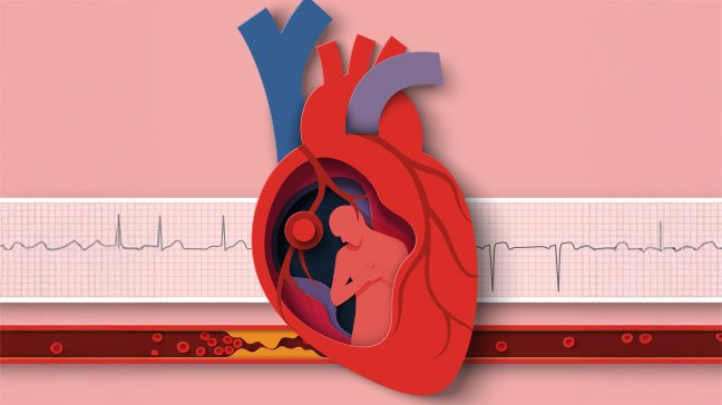 Conceptual drawing of a heart with a clogged artery and an ECG tape in the background