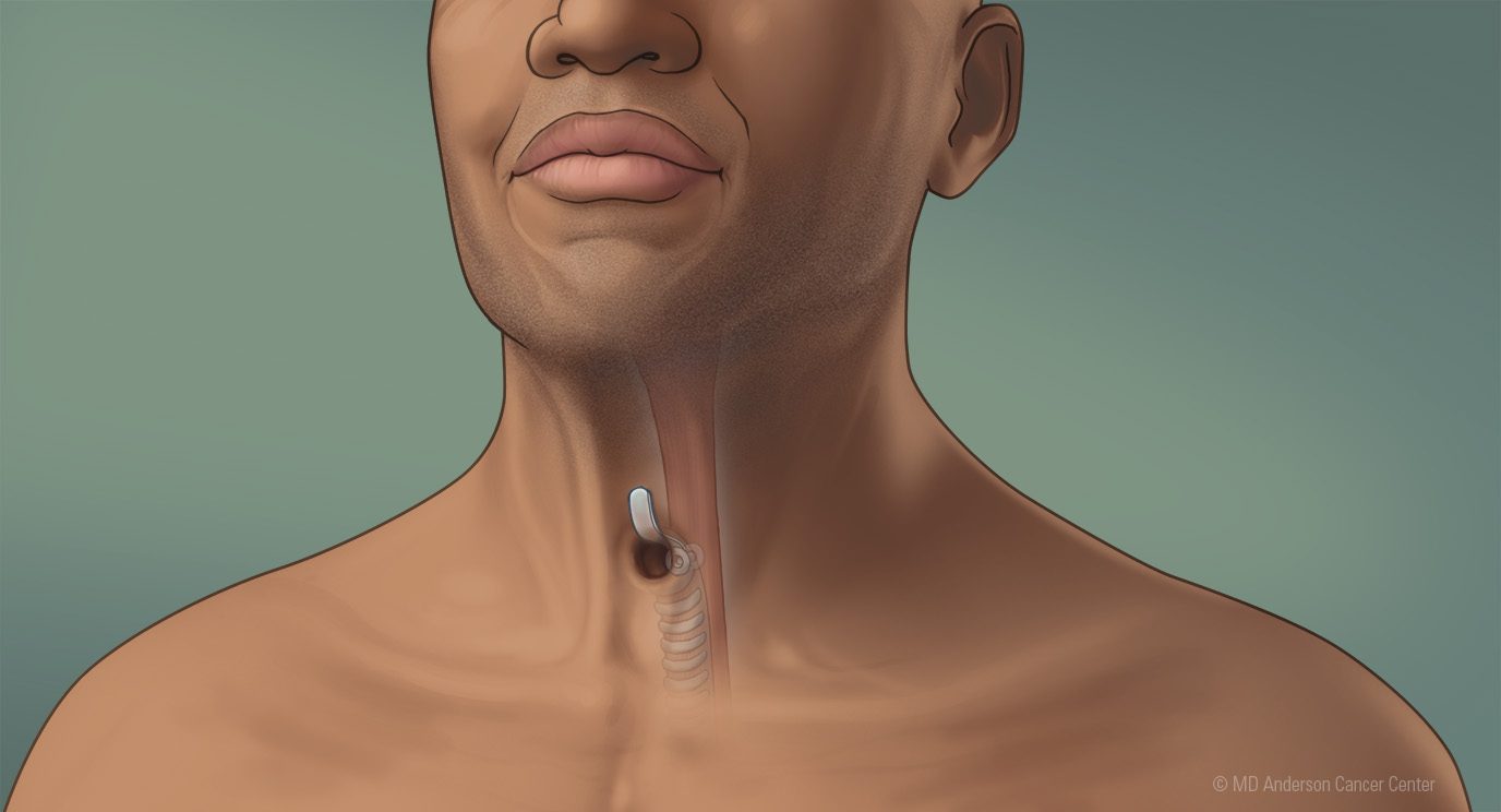 Medical illustration of a neck stoma, post-total laryngectomy