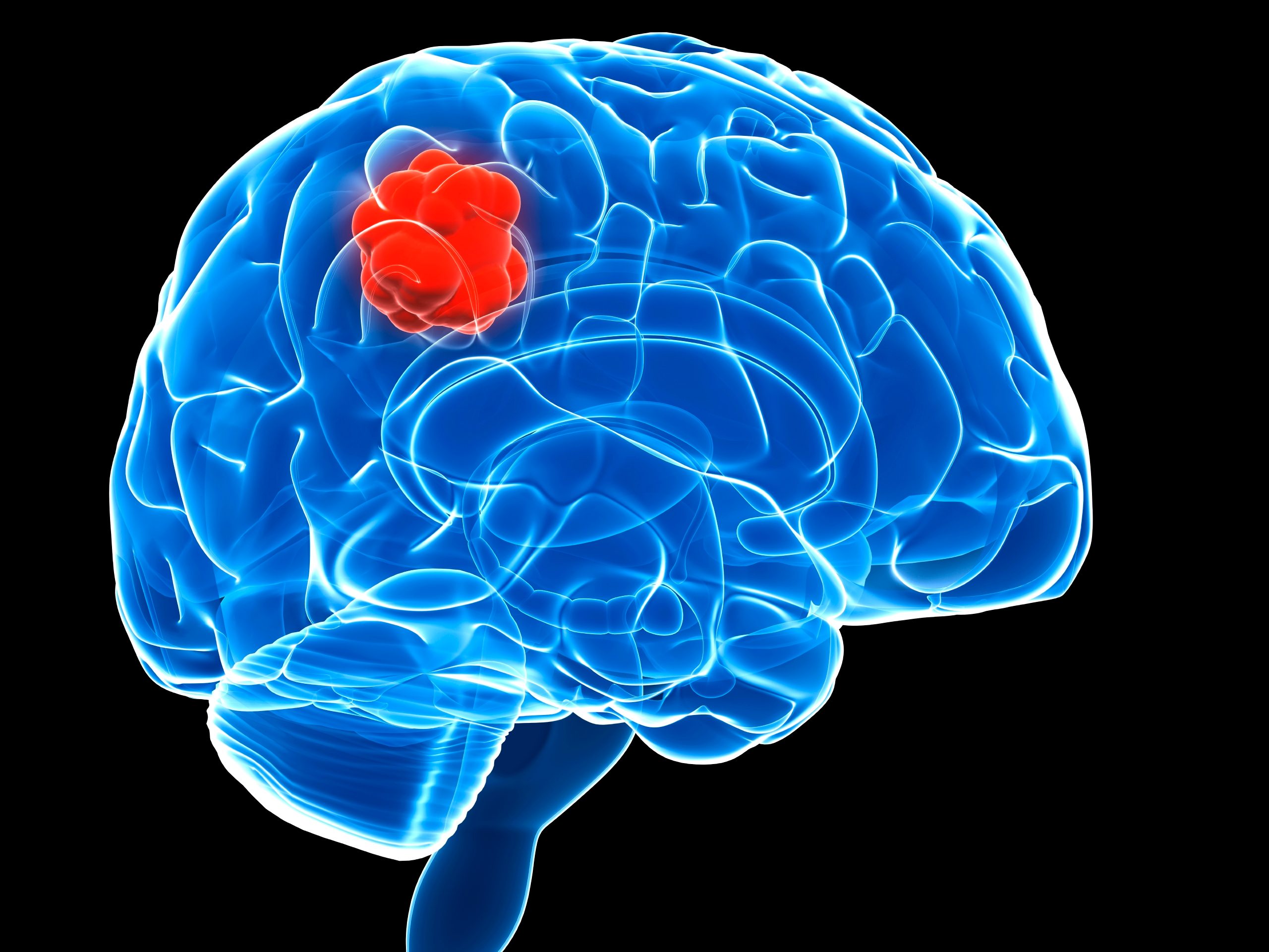 Cancerwise blog post: Coping with a brain tumor