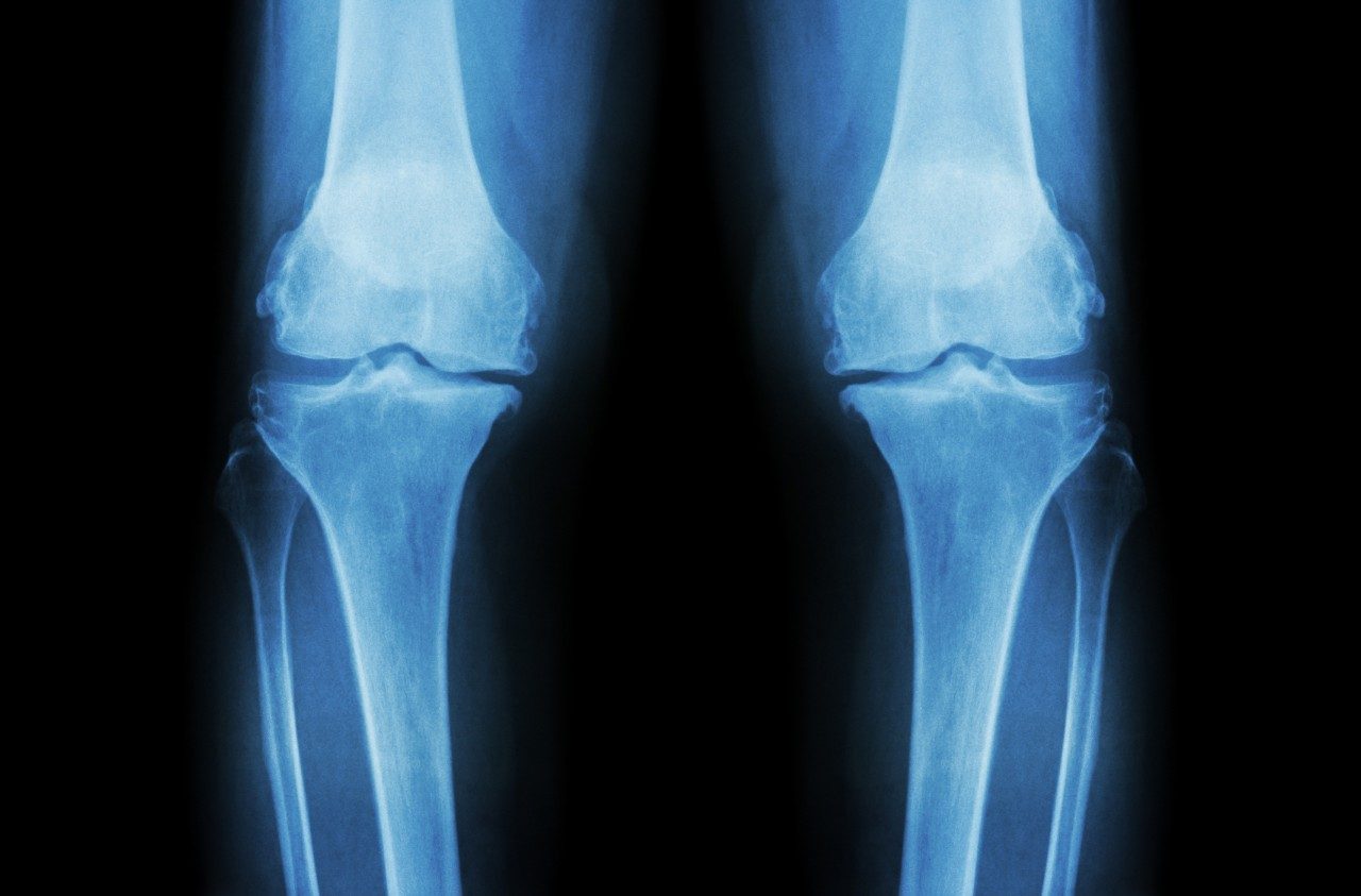 Cancerwise blog post: X-ray of knees, Ewing’s sarcoma, osteosarcoma, allografts, soft tissue sarcoma