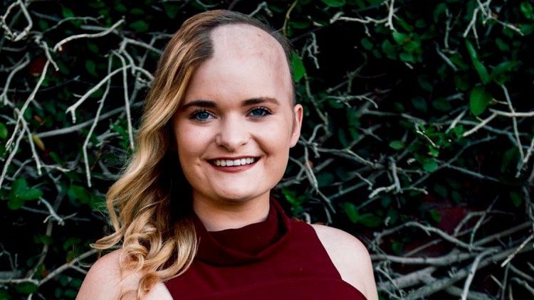 Cancerwise blog post: After brain tumor diagnosis and treatment, survivor learns to embrace herself