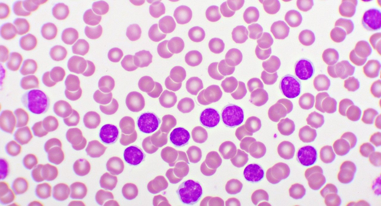 Microscope image of acute myeloid leukemia cells in the bone marrow