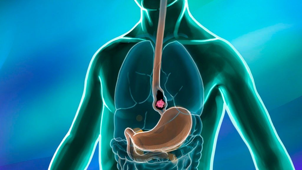 Medical illustration of esophageal cancer