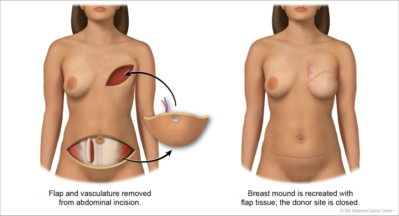 Illustration of a DIEP flap procedure in breast reconstruction by Jordan Pietz