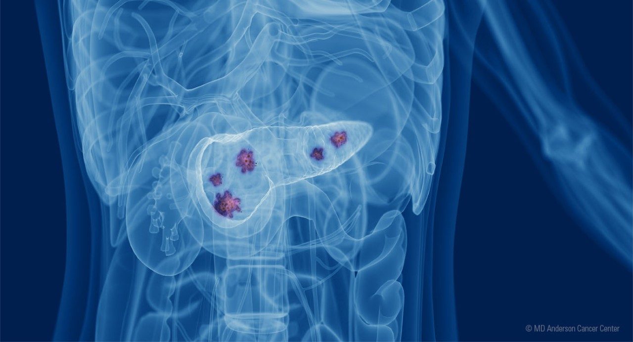 Illustration of X-ray view of diseased pancreas by Jordan Pietz