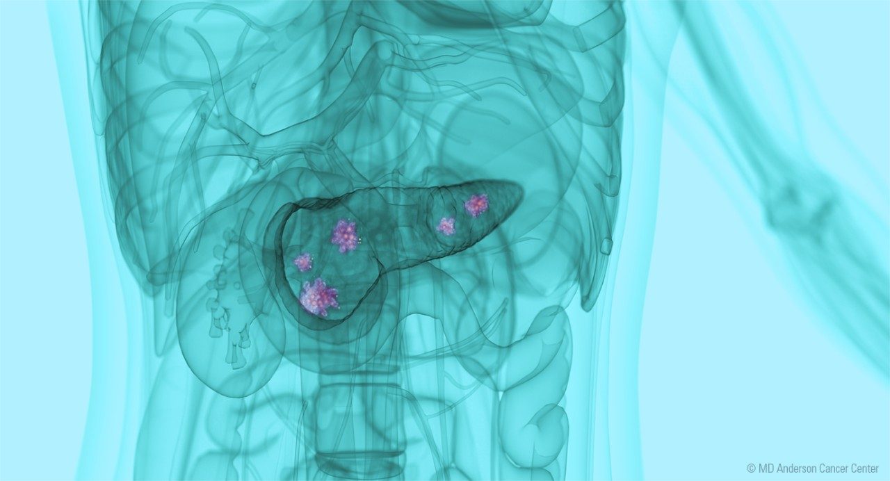 X-ray-like image of a abdomen showing the pancreas with tumors inside