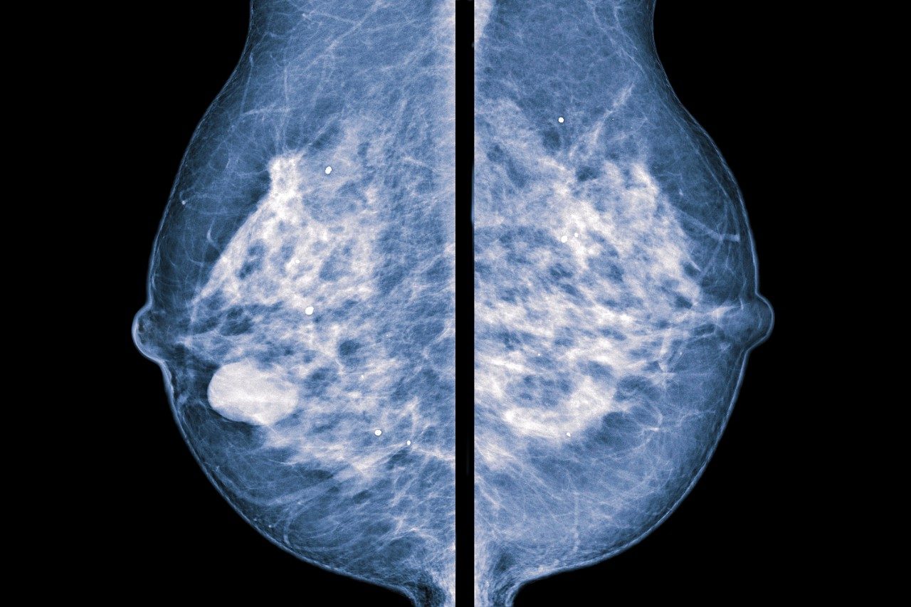 Mammogram image showing breast calcifications