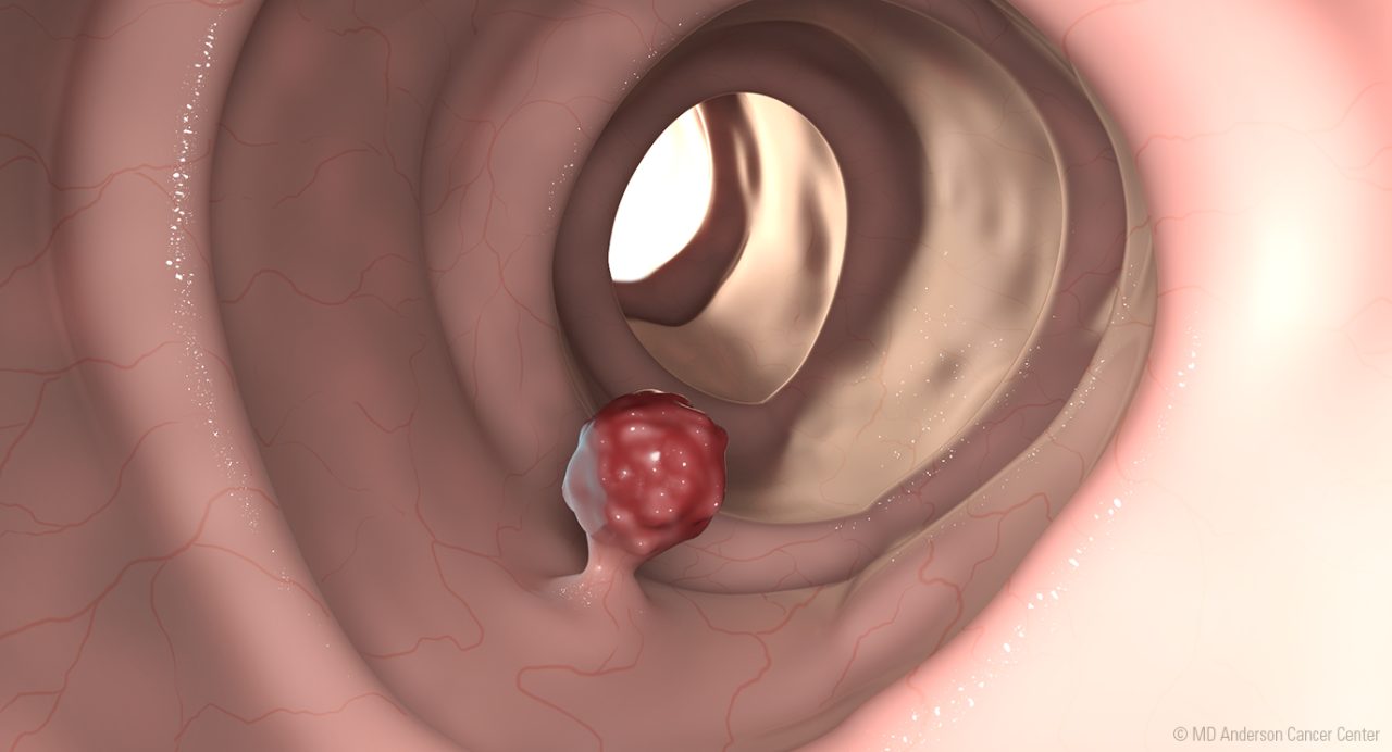 Illustration of adenocarcinoma in the colon