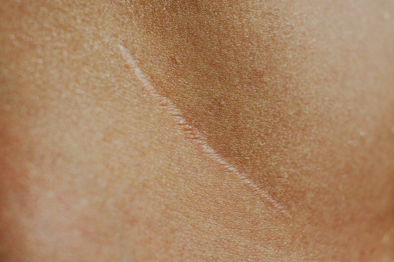 Photograph of scar on skin