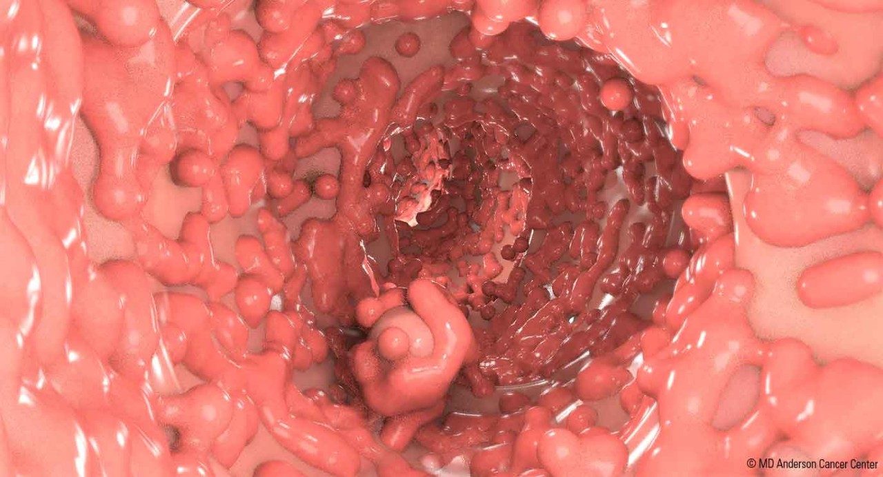 Illustration of a colon covered with hundreds of polyps