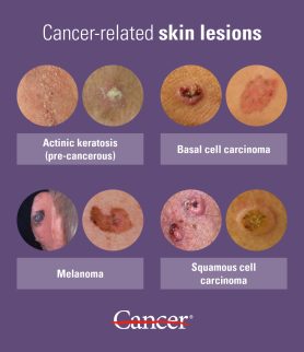 melanotic sarcoma is a skin cancer that begins with quizlet Skin cancer main image 1