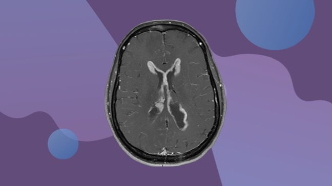 Brain scan showing leptomeningeal disease 