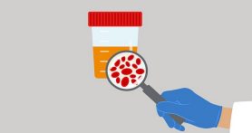 What causes blood in urine (hematuria) and what to do about it | UT MD  Anderson