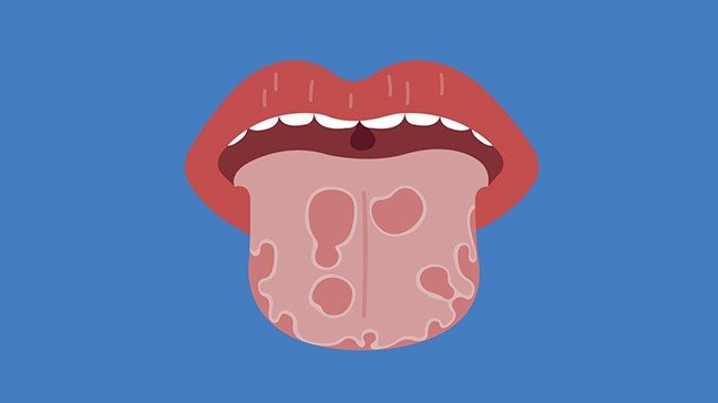 Stylized illustration of a tongue with red lesions on it