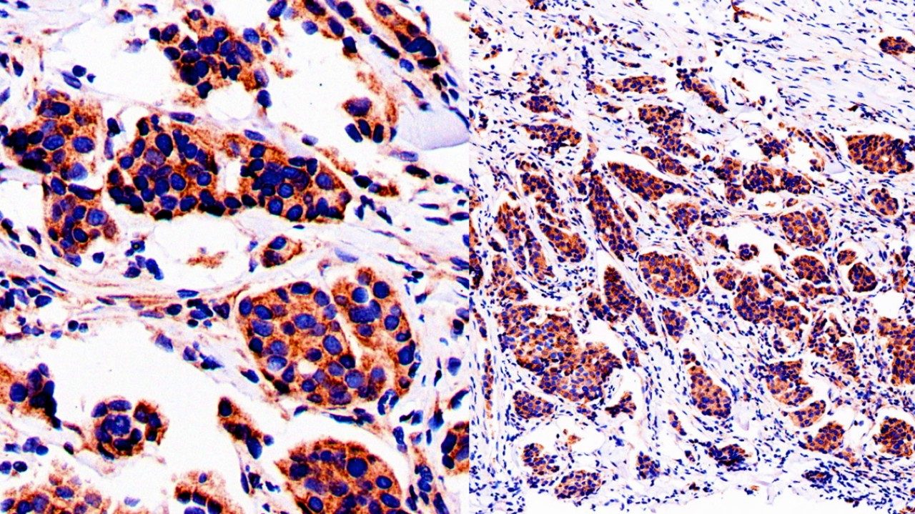 Microscopic view (enlarged at left) of metastatic bone tumor (bone metastasis) from a breast cancer patient showing strong immunohistochemical staining of the ACBP protein (brown). Image courtesy of Li Ma, Ph.D.