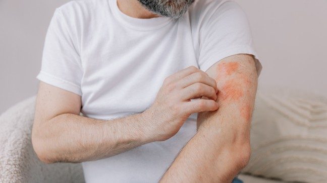 Man scratching an itchy rash on his arm