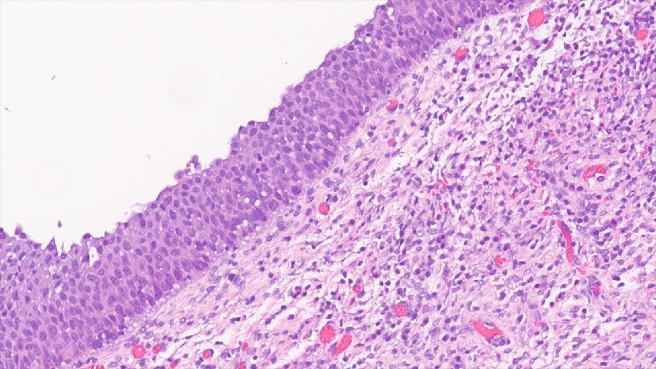 View of dysplastic cervical cells under a microscope