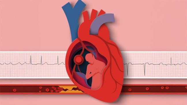 Conceptual drawing of a heart with a clogged artery and an ECG tape in the background