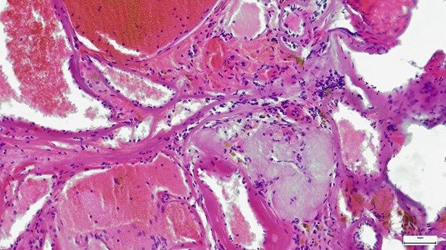 A micrograph of adenoid cystic carcinoma in the breast
