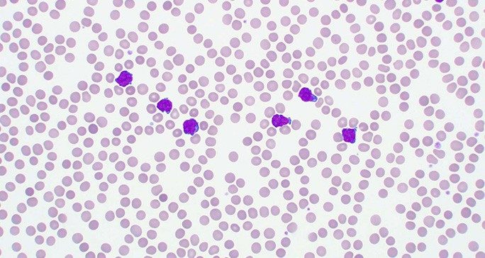 A view of   T cell prolymphocytic leukemia under a microscope