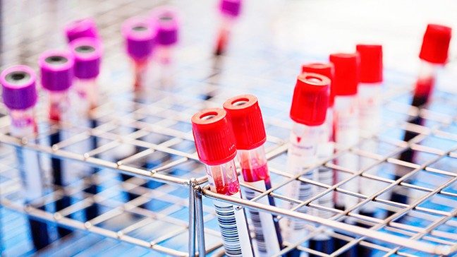 Vials of blood with red and purple caps