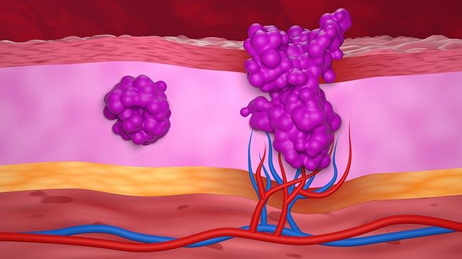 An illustration comparing benign and malignant tumors. The benign tumor on the left appears as a small, localized purple mass, while the malignant tumor on the right is larger, irregularly shaped and supported by newly formed blood vessels.