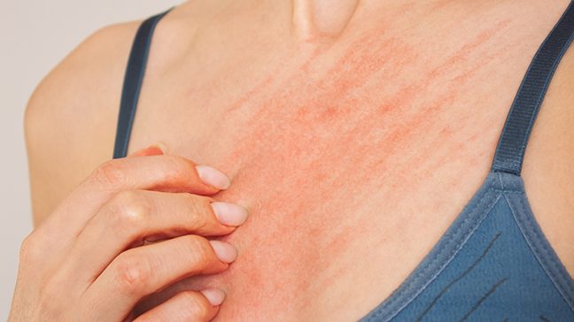 Close-up of irritated chest/breast skin being scratched