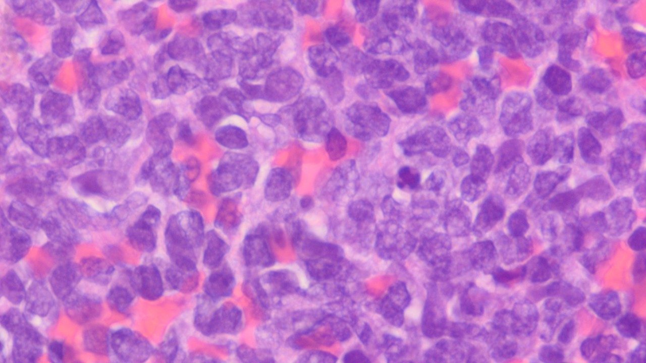 High power magnification of blastic plasmacytoid dendritic cells under a microscope