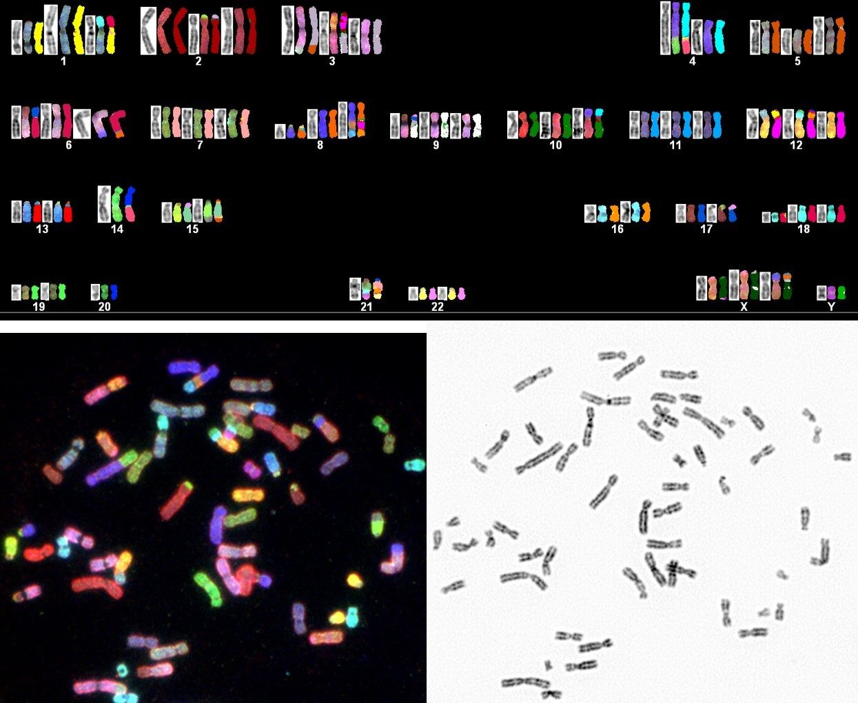 Spectrum Karyotyping Analysis (SKY) indicates complex chromosome abnormalities for a cancer patient