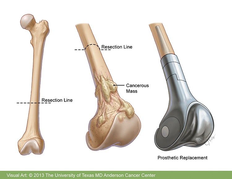5 Innovative Bone Cancer Treatment Options