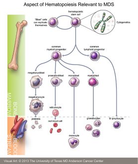 Image result for myelodysplastic syndromes.Â 