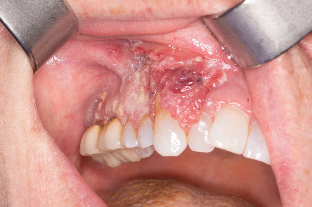 Pictures of oral cancer: A cancer of the upper gingiva, or gum. The image shows a area with red sores and white patches.