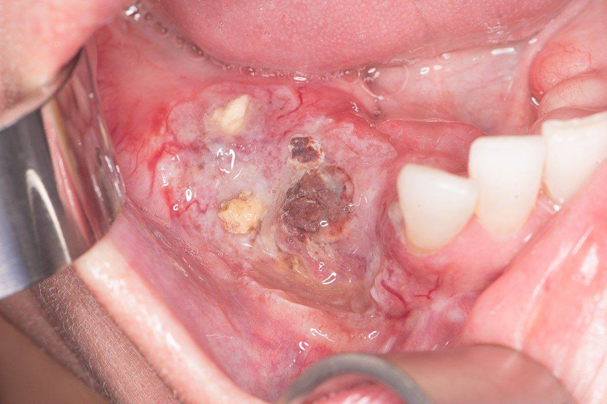 Oral Cancer - Facts, Diagnosis & Treatment | UT MD Anderson