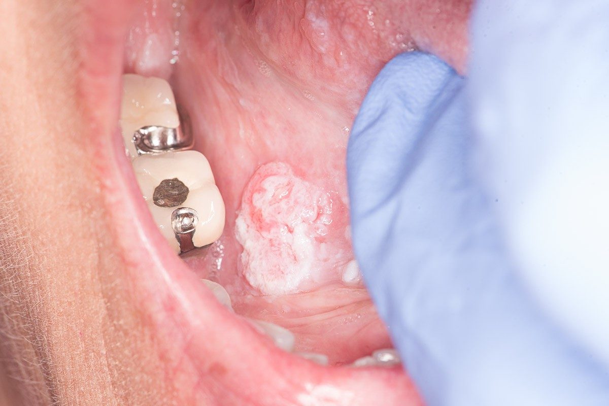 Pictures of oral cancer: A cancerous lesion on the floor of the mouth, under the tongue. The image shows a swollen white patch with distinct borders.