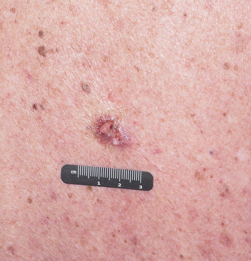 A nodular basal cell carcinoma on a patient’s back. with a pearly center, a “rolled" border and an ulcer.