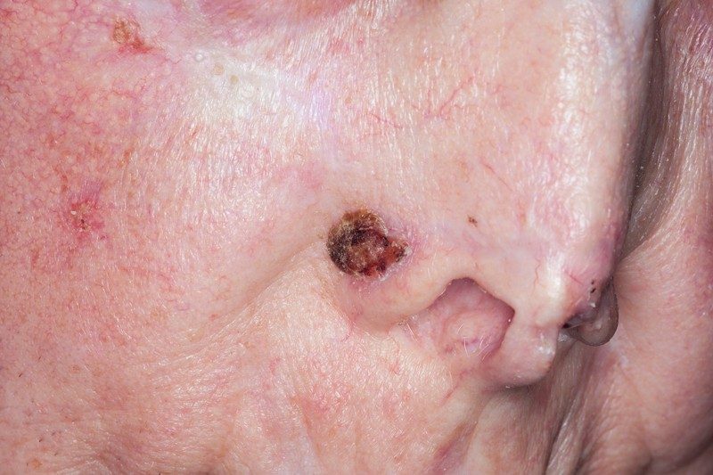 A nodular basal cell carcinoma with an open sore. It has developed on the patient’s face, a common spot for these cancers to form