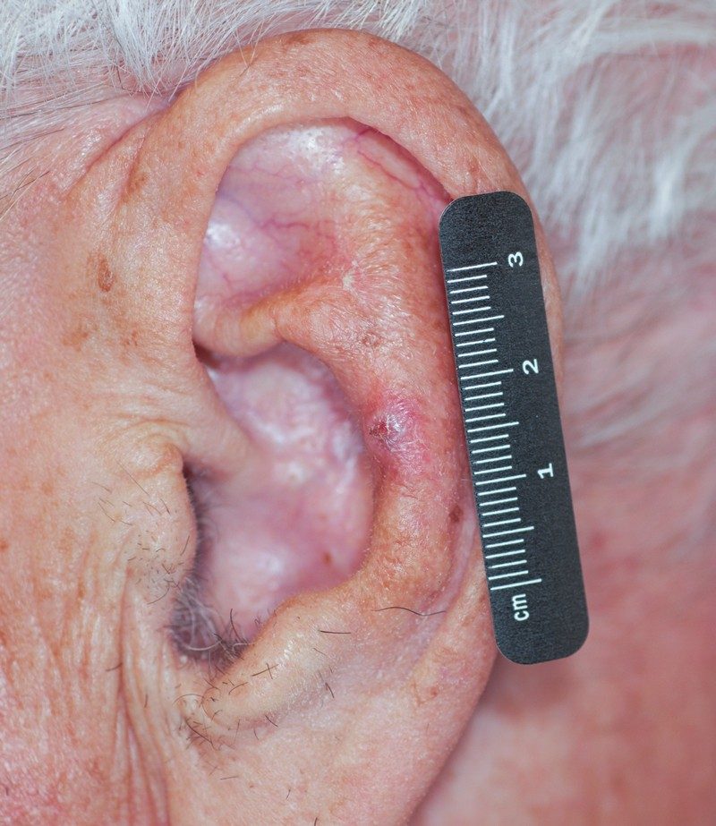 A basal dome-shaped basal cell carcinoma with an ulcer. The growth is on a patient's ear.